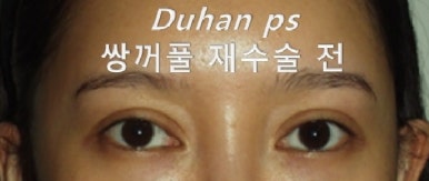 [Duhan Plastic Surgery Double Eyelid Revision Surgery] - [Asymmetric Eye Correction, Thick Ptosis, Lateral and Lower Canthoplasty] image 17