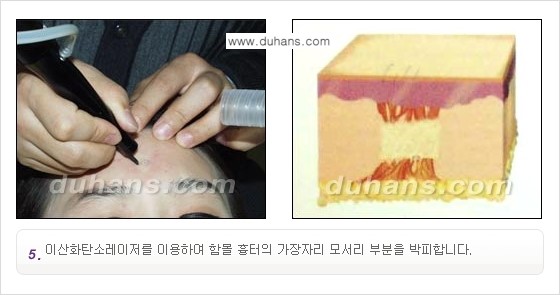 [두한성형외과 함몰 흉터 교정] - [동시에 3가지 시술로 효과적인 흉터의 교정 안내 ①] 관련 이미지 9