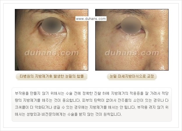 [두한성형외과 경쟁력 지방제거, 지방재배치] - [상큼하고 젊은 눈매 만들기 안내] 관련 이미지 12