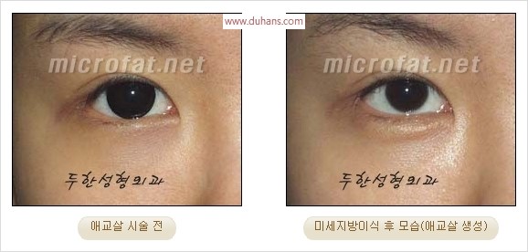 ​﻿[두한성형외과 경쟁력 지방이식] - [눈밑 애교살 시술을 위한 미세지방이식] 관련 이미지 19