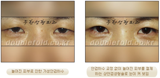 [Duhan Plastic Surgery Double Eyelid Revision Surgery] - [Ptosis, sausage eyelids] image 9