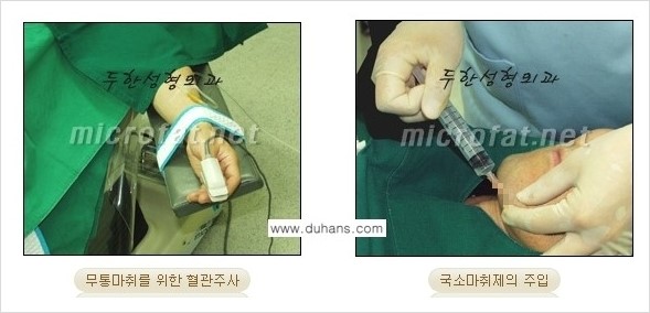 [두한성형외과 경쟁력 미세지방이식] - [타 병원의 지방이식 부작용 교정 - 정교한 마이크로 지방이식, 흡입 안내] 관련 이미지 13