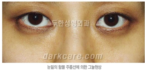 Duhan Plastic Surgery Dark Circle Improvement - What Causes Dark Circles? What Types of Dark Circles Are There? image 7