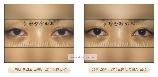 [두한성형외과 경쟁력 눈성형] - [비대칭 쌍꺼풀 라인의 여러 가지 교정 방법] 관련 이미지 13