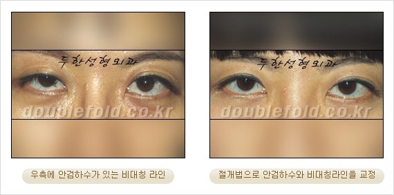 [두한성형외과 경쟁력 눈성형] - [안검하수(졸리운 눈매) 교정 방법 안내] 관련 이미지 19