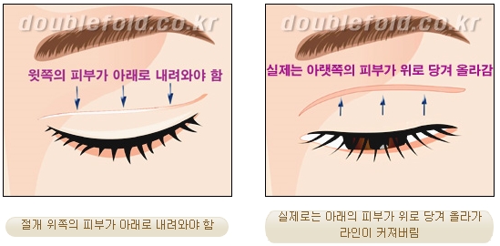 [두한성형외과 쌍커풀재수술] - [심한 소세지눈, 두줄따기, 쌍꺼풀 흉터] 관련 이미지 6