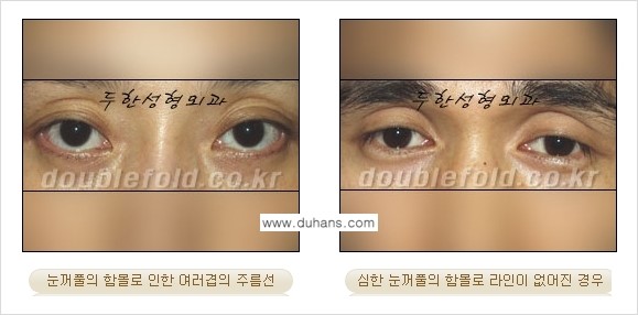 [두한성형외과 경쟁력 눈성형] - [ #꺼진눈꺼풀성형 #함몰눈꺼풀 의 쌍꺼풀 라인의 교정 안내 ②] 관련 이미지 4