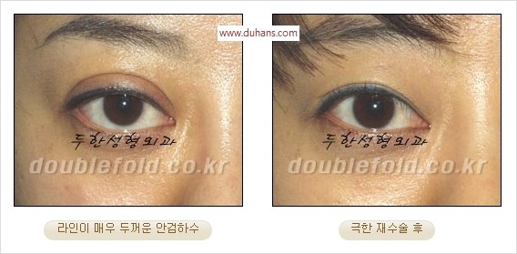 [두한성형외과 경쟁력 쌍꺼풀 재수술] - [두꺼운 라인을 교정하는 극한 재수술(Extreme Rroperation)] 관련 이미지 15
