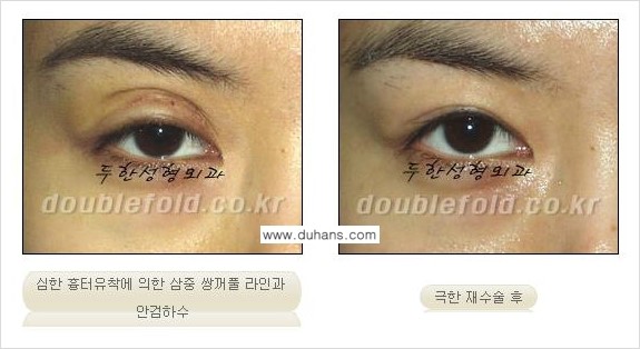 쌍꺼풀 재수술 Dr. 컬럼 관련 이미지 5