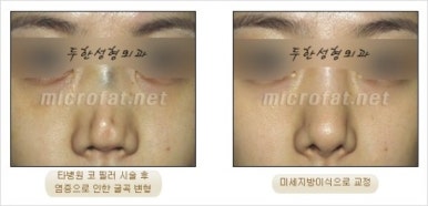 [두한성형외과 얼굴자가지방이식] - [지방이식 과정] 관련 이미지 45