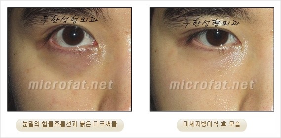 [두한성형외과 경쟁력 지방이식 리더] - [Col-fat(콜펫)지방이식, 3차원 입체지방이식, 2차원 평면지방이식] 관련 이미지 58