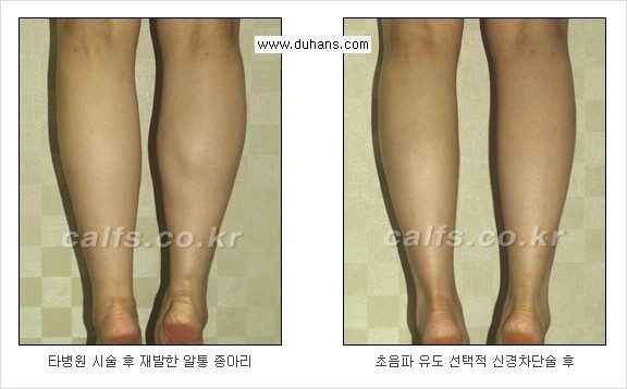 [두한성형외과 경쟁력 멀티종아리성형] - [종아리 근육 퇴축술에 관한 질문과 답변] 관련 이미지 20