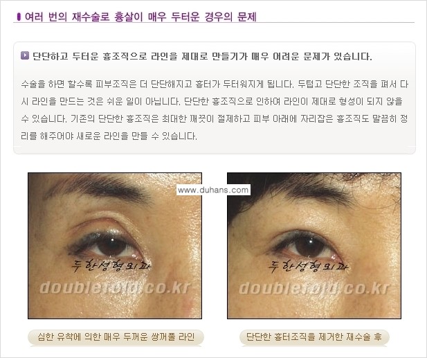 [두한성형외과 경쟁력 있는 쌍꺼풀 재수술] - [극복해야 할 극한의 상황과 문제들] 관련 이미지 5