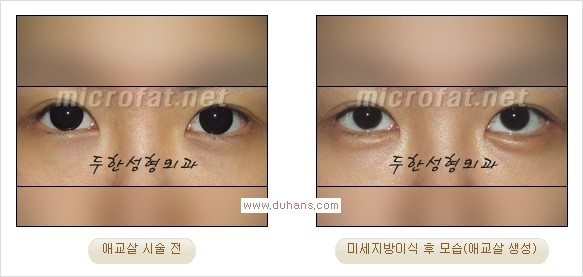 [두한성형외과 경쟁력 눈밑성형] - [타 병원 필러 애교살 시술 부작용을 미세지방이식으로 교정] 관련 이미지 17
