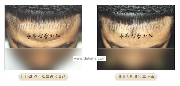 [두한성형외과의 경쟁력 있는 지방이식] - [이마 미세지방이식 2.] 관련 이미지 12