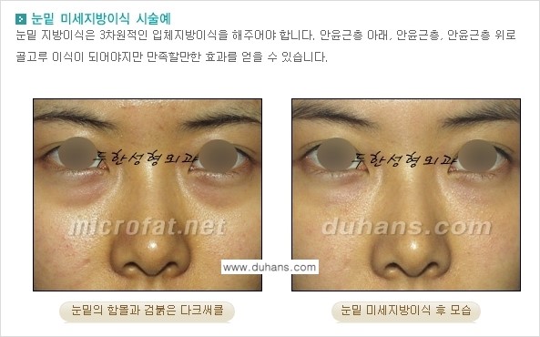 [두한성형외과 경쟁력 미세지방이식] - [다크써클 & 눈밑주름 미세지방이식 3.] 관련 이미지 4