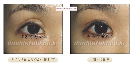 [두한성형외과 경쟁력 쌍꺼풀 재수술] - [두꺼운 라인을 교정하는 극한 재수술(Extreme Rroperation)] 관련 이미지 11