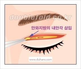 [두한성형외과 경쟁력 눈성형] - [타 병원에서의 쌍꺼풀 재수술 실패의 원인을 분석] 관련 이미지 6