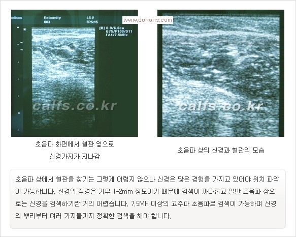 [두한성형외과 경쟁력 멀티종아리성형] -  [종아리 축소술의 여러 가지 종류] 관련 이미지 17