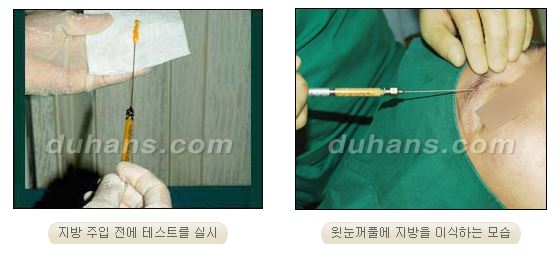 ✨눈 위 꺼짐, 단순 미용이 아닌 기능까지 고려해야 하는 이유✨ 관련 이미지 6