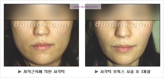 [두한성형외과 경쟁력 안면윤곽 성형 리더] - [완변한 V 라인! 턱 미세지방이식, 볼살 미세지방이식, 사각턱 보톡스 안내] 관련 이미지 34