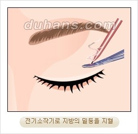 ⁠⁠[두한성형외과 경쟁력 안검성형] - [젊은 눈매를 위한 윗눈꺼풀 지방제거, 눈밑 지방제거] 관련 이미지 8