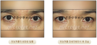 [Doohan Plastic Surgery Autologous Fat Grafting] - [Sunken Eye Fat Grafting] image 34