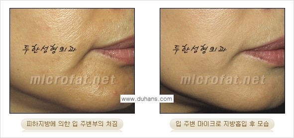 [두한성형외과 경쟁력 지방흡입] - [얼굴 지방흡입 부작용 교정방법 안내] 관련 이미지 16