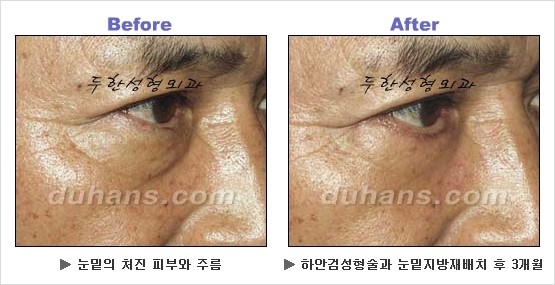 [두한성형외과 경쟁력 동안성형 리더] - ​[미간주름, 이마주름, 안검성형, 이마거상술, 눈썹거상술] 관련 이미지 111