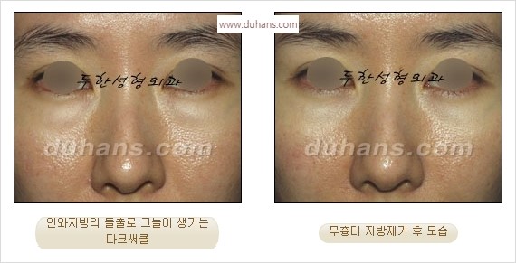 ⁠⁠[두한성형외과 경쟁력 안검성형] - [젊은 눈매를 위한 윗눈꺼풀 지방제거, 눈밑 지방제거] 관련 이미지 33