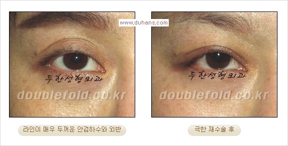 [두한성형외과 경쟁력 쌍꺼풀 재수술] - [피부 여유분이 부족해서 토안증이 발생한 경우 극한 재수술] 관련 이미지 2
