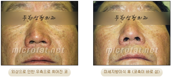 [두한성형외과 지방이식] - [지방이식을 이용한 코성형] 관련 이미지 11