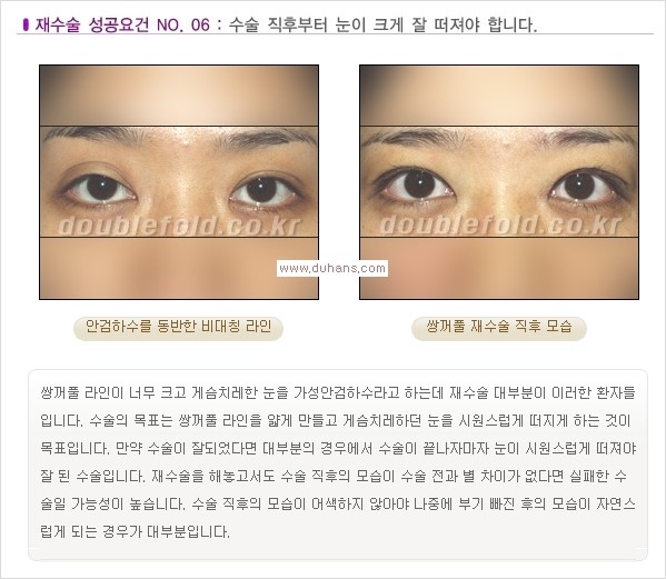 [두한성형외과 경쟁력 쌍꺼풀 재수술, 극한 재수술]- [쌍꺼풀 재수술의 성공 조건(Condition of successful reoperation) 관련 이미지 8