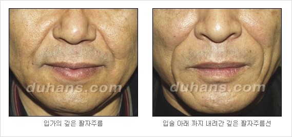 [Dr. 컬럼] - [주름교정을 위한 미세지방이식] 관련 이미지 4