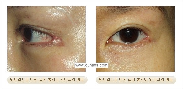 [두한성형외과 NO.1 눈성형] - [뒤트임 수술에 대한 정보] 관련 이미지 4