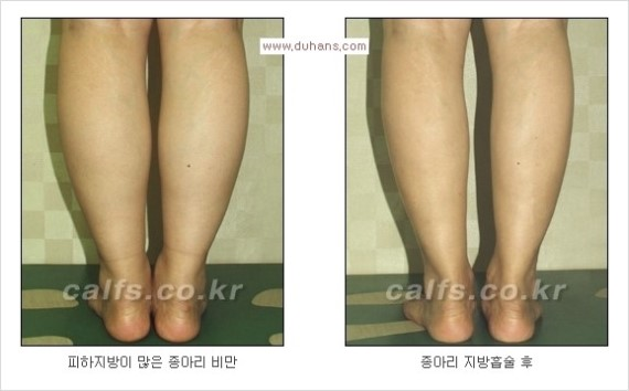 [두한성형외과 경쟁력 종아리성형 리더] - [종아리 성형 안내] 관련 이미지 15