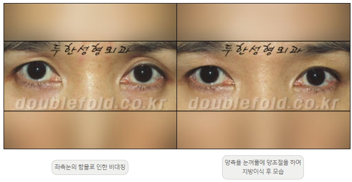[두한성형외과 쌍커플재수술] - [비대칭 쌍커풀 라인] 관련 이미지 23