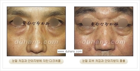 [두한성형외과 경쟁력 눈성형] - [젊은 눈매로의 복원 안검성형] 관련 이미지 14