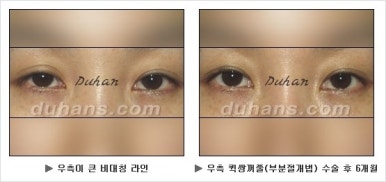 Best Place for Double Eyelid Revision Surgery, Duhan Plastic Surgery - Partial Incision Eye Revision Surgery image 18