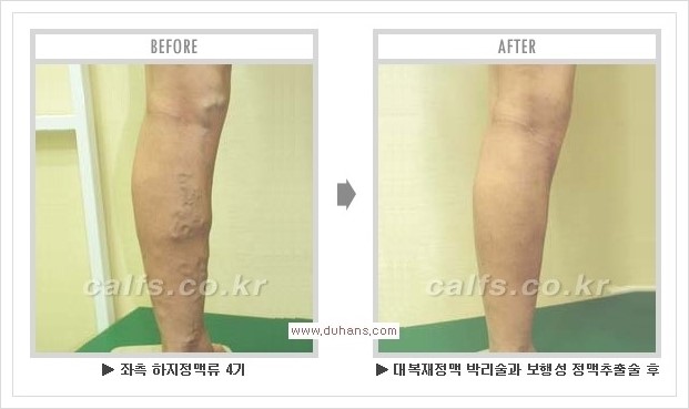 [두한성형외과 경쟁력 멀티종아리성형] - [종아리성형 방법별 전후 주의사항] 관련 이미지 39