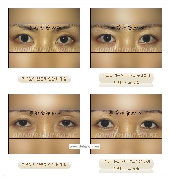 [두한성형외과 경쟁력 쌍꺼풀 재수술] - [짝짝이(비대칭) 쌍꺼풀 라인 교정하는 방법 안내 2.] 관련 이미지 8