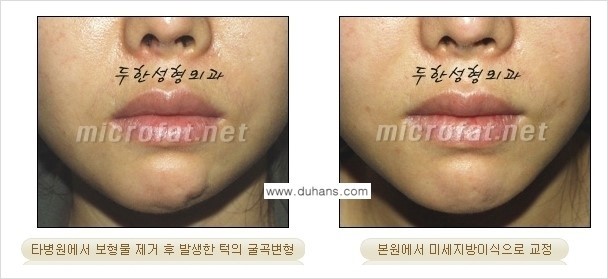 [두한성형외과 경쟁력 미세지방이식] - [부드럽고 아름다운 얼굴윤곽선 턱(하악부) 미세지방이식 안내] 관련 이미지 7
