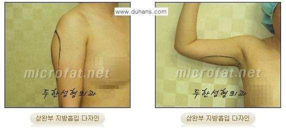 [두한성형외과 경쟁력 바디성형] - [아랫배, 윗배, 옆구리살, 허리살, 팔뚝살 지방흡입] 관련 이미지 5