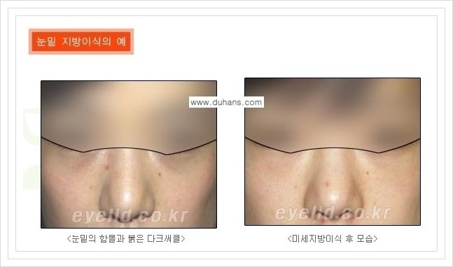 [두한성형외과 경쟁력 눈밑성형] - [눈밑 미세지방이식으로 다크써클 치료] 관련 이미지 10