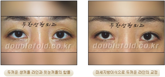 [Eye Reoperation Duhan Plastic Surgery] - [Guide to Double Eyelid Revision Surgery] image 50