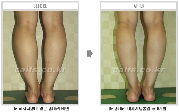 [종아리성형 두한성형외과] - [종아리수술에 대한 자주하는 질문과 답변 모음] 관련 이미지 76