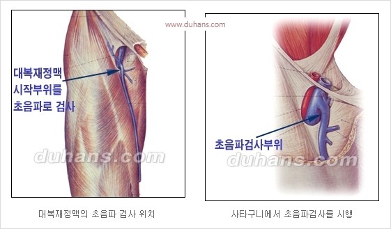 [두한성형외과 경쟁력 정맥류 치료] - [정맥류 치료의 모든 것] 관련 이미지 6
