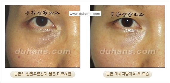 [두한성형외과 경쟁력 미세지방이식] - [다크써클 & 눈밑주름 미세지방이식 4.] 관련 이미지 14