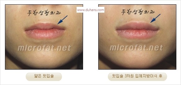​​[두한성형외과 경쟁력 미세지방이식] - [볼륨감 있는 입술성형] 관련 이미지 23