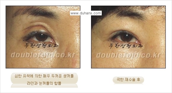 [두한성형외과 NO.1 "극한 눈 재수술"] - [극한 눈 재수술 성공사례 ①] 관련 이미지 2